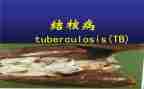 2024年结核病防治工作总结7篇